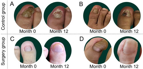 Figure 4. Comparison of outcomes at baseline and 12 months post-intervention between the control group and surgical group (toes): (A) control group: This patient, who had their nail removed due to severe nail plate deformity, exhibited malformed regrowth of the nail plate with compromised transparency at follow-up. (B) Control group: without any specific treatment, no significant alteration in the nail bed is observed in this patient after 12 months. (C, D) Surgery group: as can be seen, the newly formed nail plate is more symmetrical and exhibits a smoother surface after the surgical intervention. There is also an increase in the nail bed’s length and width, which validates the efficacy of the surgical approach employed in this study.
