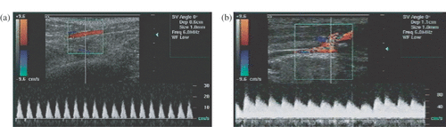 Figure 4. Pulsed Doppler spectrum obtained from the femoral artery before and after the injury was produced. (a) Normal arterial blood flow before the injury. (b) Bleeding artery shows a spectrum with increased baseline and elevated peak amplitude.