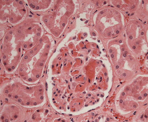 Figure 1. Microscopic image of the kidney with microthrombi in capillaries of a glomerulus. Haematoxylin and eosin stain (200 × magnification).