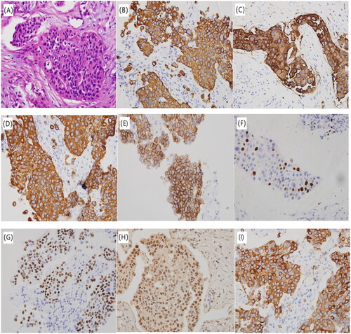 Figure 3. Cervical lymph node biopsy results. (A) HE staining (×400) showed indicates migratory cell carcinoma on cervical lymph node puncture; (B) IHC (×400) showed positive CAm5.2 expression; (C) IHC (×400) showed positive CK-P expression; (D) IHC (×400) showed positive CK8/18 expression; (E) IHC (×400) showed positive HER2 expression (3+); (F) IHC (×400) showed positive Ki67 expression; (G) IHC (×400) showed positive P40 expression; (H) IHC (×400) showed positive P63 expression; (I) IHC (×400) showed positive Uroplakin expression.