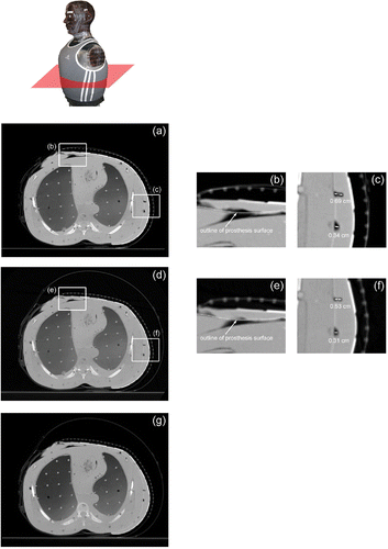 Figure 6. Axial CT cross-sections from the lower torso of a CT phantom fitted with the multilayer conformal applicator. (a) Axial cross-section of lower torso prior to air bladder inflation; (b) close-up of bolus over breast and sternum prior to air bladder inflation; (c) close-up of small air pockets under the arm prior to air bladder inflation; (d) axial cross-section of lower torso after air bladder inflation; (e) close-up of bolus over breast and sternum after air bladder inflation; (f) close-up of reduced air pockets under the arm after air bladder inflation; (g) axial cross-section of lower torso after simulated patient movement.