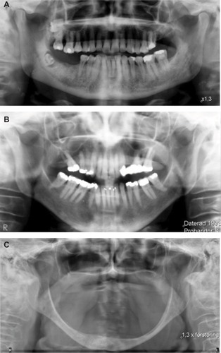 Figure 1 The three panoramic radiographs show the large variation in bone mass, trabeculation, and basal cortex in persons 79- or 80-years-old.