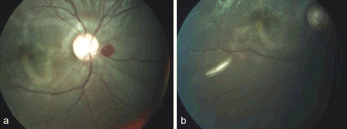 FIGURE 1  Color fundus photograph of the right eye showing hemorrhage nasal to the disc margin and multiple subretinal tracks involving the macula. In the inferotemporal region white subretinal larva is seen.