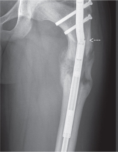 Figure 4. Radiograph from a 16-year-old boy, 6 months after implantation of a femoral PRECICE with a trochanteric approach for lengthening of 50 mm. After 3 months (35 mm), repeat osteoclasia due to early consolidation had become necessary. Breakage of the welding seam (arrow) occurred a further 3 months later, 1 month after the end of the distraction period.