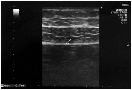 Figure 1. Ultrasonographic apperance of the peritoneal wall (0.7 mm) (white arrow).