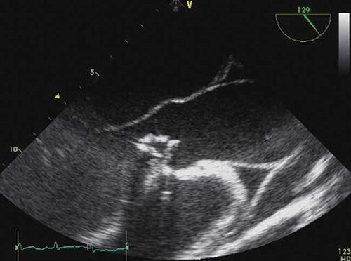 Figure 3. The vegetation was related with both non-coronary and right coronary cusps of the aortic valve in the transesophageal echocardiogram.
