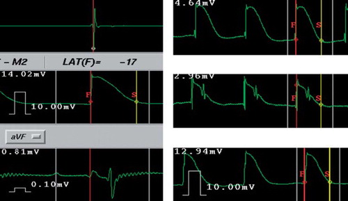 Figure 2. Example screen captures from the CARTO MAP mapping system. Left: Sample window of the CARTO system showing simultaneous recordings of the time reference electrogram from coronary sinus (upper tracing), the monophasic action potential (MAP, middle tracing) and the surface ECG (lower tracing) from pig 1 (time scale 100 mm/s). On the MAP recording, the first annotation line (F, red) was set at the onset of the rapid phase of the MAP upstroke, representing the regional activation and the second line (S, yellow) at the 90% repolarization point, representing the local end of repolarization. The MAP duration is the time interval between the two annotation lines. Right: Typical MAP recordings from pig 4 (upper tracing), pig 7 (middle tracing) and pig 5 (lower tracing), time scale 50 mm/s. Note that MAP recordings from Pig 7 (middle tracing) are from a lower site near the tricuspid annulus and contain a contaminant of QRS complex; however, the measurement of MAP intervals is not influenced.