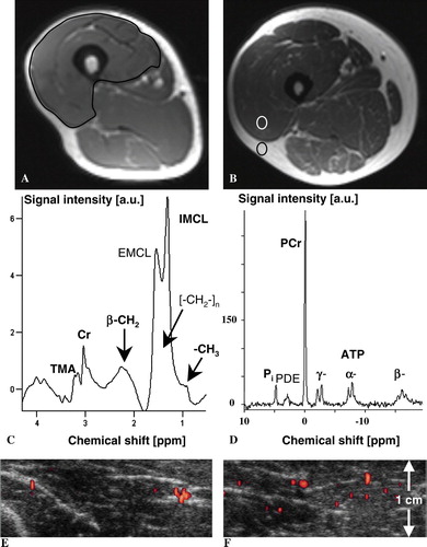 Figure 1.  Magnetic resonance T1-weighted imaging of the right thigh in a 54-year old man with cachexia due to pancreatic cancer (weight 58 kg) (A) and the corresponding right thigh at the same level of the matched healthy volunteer (55 years, weight 107 kg) (B). In A), determination of muscle cross-sectional area (CSA) of the right quadriceps femoris is illustrated (CSA in patient with cachexia vs. volunteer, 51.3 vs. 85.9 cm2). In B), the quantification of the ratio of signal intensities of muscle and subcutaneous fat tissue using a region-of-interest analysis is illustrated. The corresponding 1H MR spectrum (C) from the right vastus lateralis muscle and the 31P MR spectrum of the same region (D) of the patient with cachexia illustrate the metabolites that were quantified. Peak assignments in C): Cr, (phospho-)creatine; TMA peak, trimethyl-ammonium-containing compounds among which is choline; IMCL, intramyocellular lipids; EMCL, extramyocellular lipids. Peak assignments in D): Phosphocreatine (PCr), inorganic phosphate (Pi), phosphodiester (PDE), and the three resonances (α, β, γ) of adenosine 5′-triphosphate (ATP); intensity ratio β-ATP/PCr in patient with cachexia vs. volunteer, 0.27 vs. 0.27. Only the signals printed in bold in C) and D) were quantified. The corresponding transverse power Doppler images after bolus injection of 10 ml Levovist® in 1.5 cm depth (focus area) show the initial increase (E) and maximum plateau (F) of microbubbles’ replenishment within the right vastus lateralis muscle of the patient with cachexia. Microcirculation and concentration of lipid and energy metabolites in vivo were comparable in muscles of volunteers and cachectic patients at rest.