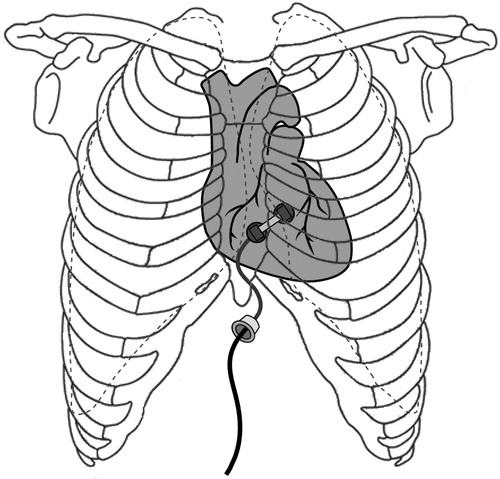 Figure 1. The tethered crawling robot is introduced into the thoracic cavity through a small port below the sternum (green circle), avoiding the area occupied by the lungs (outlined by the dashed blue line). It attaches to the epicardial surface of the heart and travels to the desired location for therapy under control of the physician. [Color version available online]