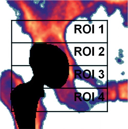 Figure 1. Four regions of interest for DEXA measurements, “the Wilkinson regions”. (Figure used from Laursen et al. Citation2007 with permission).