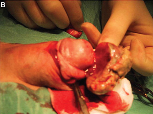 Figure 1b. The tumor emanates from the prepuce and was removed by a radical circumcision.