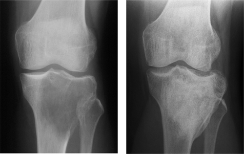 Figure 2. A. Giant cell tumor of the proximal tibia filled with autologous and allogeneous bone. B. After 6 years, there were no signs of recurrence and there was good consolidation.