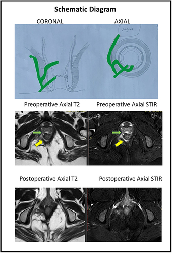 Figure 4 A 36-year old female patient with posterior horseshoe anal fistula and an RVF-II fistula opening in the left posterior vagina. She underwent the TROPIS procedure. Upper panel: Schematic diagram of coronal (left side) and axial sections (right side). Middle panel: Preoperative magnetic resonance imaging - Axial sections: T2 weighted (left side) and Short Tau Inversion Recovery (STIR) (right side) (yellow arrows showing fistula tract, green arrows showing fistula tract opening into vagina). Lower panel: Postoperative magnetic resonance imaging- 2 months after surgery - Axial sections: T2 weighted (left side) and Short Tau Inversion Recovery (STIR) (right side showing the complete healing of the fistula.