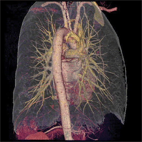Figure 2. Self-study material in QuickTime VR format. Volume rendering of CT image of the heart, aorta, pulmonary arteries and veins, dorsal aspect. One image from a file containing approximately 400 projections, selected by moving the mouse in the image.
