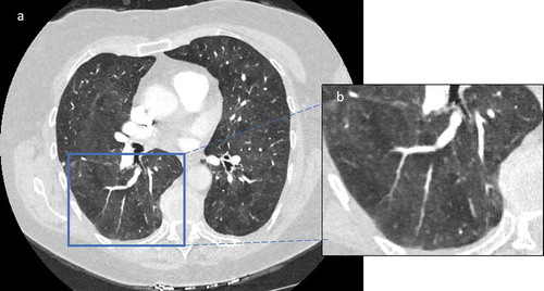Figure 8. Chest computerized tomography scan displaying ground glass opacities along with the mosaicism (air-trapping) “head and cheese” sign , in a patient with hypersensitivity pneumonitis. Figure A represent the cross-section of the CT scan and Figure B represent the magnified view of the selected section of CT image.