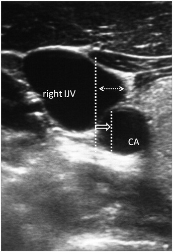 Figure 1. Ultrasound image of the right IJV and relationship with CA. Interrupted white arrow represents the overlap between CA and IJV. Short arrow shows 25% diameter of CA and long arrow shows 50% diameter of CA. IJV, internal jugular vein; CA, carotid artery.