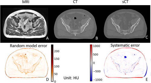 Figure 1. Example of MRI (a), CT (B), and sCT (C) for a corresponding slice, along with associated random model error (i.e., the standard deviation of the 50 sub-sCTs; D) and the systematic error of sCT (i.e., the difference between the CT and the sCT; E).