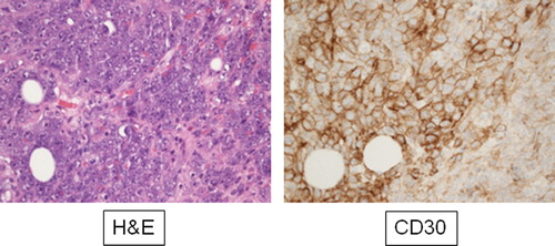 Figure 1. Hematoxylin and eosin-stained sections showing tumor cells with positive reaction to CD30 marker.