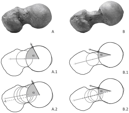 Figure 1. 3-point and anatomic method compared in high alpha angle (A) and low alpha angle (B). 3-point method (A.1 and B.1) uses the midpoint of the femoral neck at its narrowest point. The anatomic method (B.2 and B.2) defines the femoral neck axis by connecting the centers of 3 circles projected over the neck contour. The axis is translated to the center of the femoral head if necessary, to measure the alpha angle. In this example, alpha angle A.1 = 64˚, A.2 = 73˚. Angle B.1 and B.2 are both 30˚, while the femoral head is positioned central on the femoral neck.