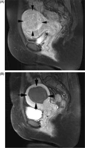 Figure 5. (A) CeMRI picture of myoma before ablation shows the fibroid was obviously enhanced. (B) Sagittal ceMRI of the pelvis following PMTA of a fibroid in the posterior wall of uterus. No enhancement is seen in the fibroid.
