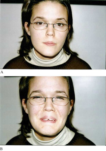 Figure 1. The patient exhibiting the inverted facial expression typical of urofacial syndrome: A) when sad/crying, but her expression indicates no overt emotion; B) when smiling, but her expression suggests sadness/crying.