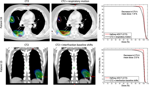 Figure 4. Examples of tumor motion. The GTV-t is contoured in red and CTV-t is contoured in pink. The dose distribution is shown as dose color wash with a minimum dose shown at 95%, and a maximum dose at 107%. Upper: transversal CT slice of Patient 16 at CT2 without and with inclusion of respiratory tumor motion. Lower: Coronal view of Patient 13 at CT2 without and with inclusion of interfraction baseline shifts. The corresponding CTV-t DVHs are shown to the right.
