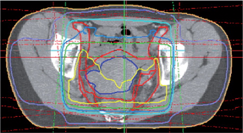 Figure 1. Dose distribution from radiotherapy of a cervical cancer patient. The yellow, light blue, and purple lines represent the 50-Gy, 45-Gy, and 25-Gy isodoses, repectively. The 4 radiation fields applied in patients with cervical cancer encompass the whole pelvis, the distal border of the fields being 0–10 mm below the obturator foramen. Depending on the radiotherapy technique used, the acetabula receive 30–50 Gy while the lateral parts of the hip are irradiated with 10–30 Gy.