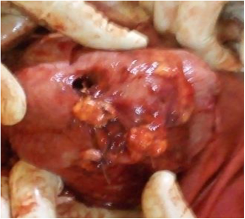 Figure 2 Intraoperative photographs of fundal niche with the surgeons glove visible and anterior uterine wall fibro-fatty adhesion (released) and lower uterine segment transverse cesarean section hysterectomy incision.