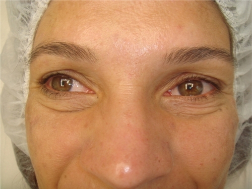 Figure 3A Monopolar radiofrequency treatment of lower eyelids before treatment. The usual treatment series is four to six applications.