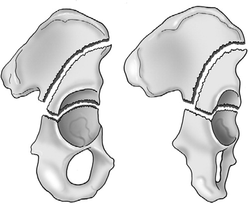 Figure 2. The transverse fracture with a floating acetabular dome in 75° (A) and 150° (B) oblique view. The acetabular dome is neither connected to the axial skeleton of the ileum nor to the ischium or the pubic bone.