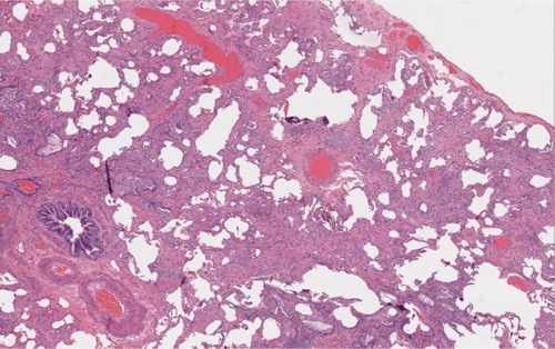 Figure 3 Histopathology in a patient with RA-ILD associated NSIP. A surgical biopsy specimen in a patient with RA showing cellular interstitial infiltrates and fibrosis in a temporally uniform distribution.