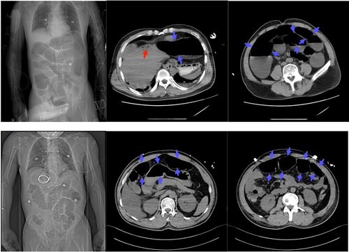 Figure 2. Represented radiographic images of abdomen. The first row of images shows patient 9, the second row shows patient 10. The images illustrate hepatic portal venous gas (red arrow) and dilated bowel (blue arrow).