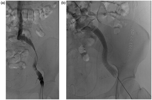 Figure 3. (a and b) A 44-year-old female with acute left leg swelling 14 days post-operatively. (a) Angiography showed extensive stenosis of the iliac vein caused by kinking. (b) Two bare stents in series were inserted and achieved perfect patency.