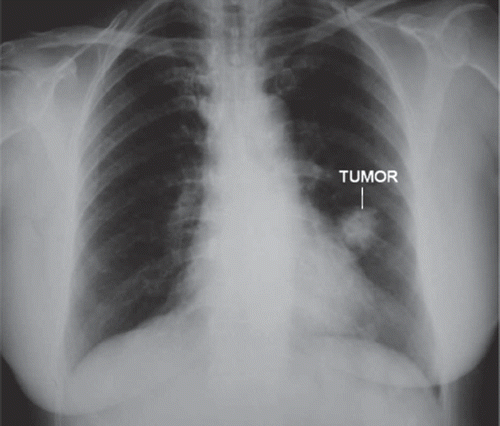 Figure 1. Chest x-ray. A 2 cm dense mass was demonstrated in the upper lobe of the left lung.