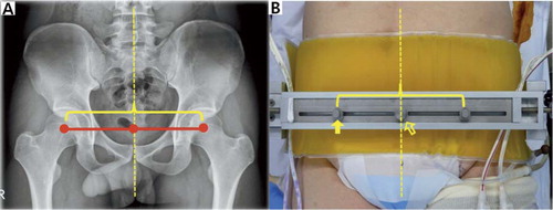Figure 3. A. The distance between femoral head centers on both sides was measured on a radiograph of the pelvis. B. A customized metal ruler with two mobile pegs was developed to replicate the inter-femoral head distance. Dotted line: pelvic midline; empty arrow: center rod; solid arrow: mobile peg (landmark X).