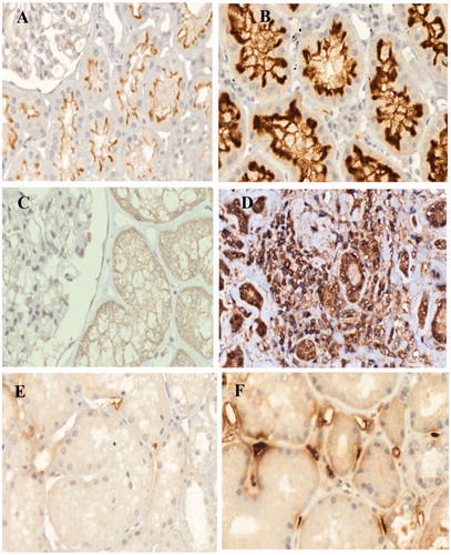 Figure 2. Intrarenal renin–angiotensin system and transforming growth factor β1. Angiotensin-converting enzyme (ACE): Control group (A)—mild staining of proximal tubules brush border; CAN group (B)—intense staining of proximal tubules brush border. Angiotensin II (Angio II): Control group (C)—negative; CAN group (D)—positive staining in atrophic tubules and interstitial cells. Transforming growth factor β1 (TGFβ1): Control group (E)—mild focal staining of peritubular capillaries; CAN group (F)—intense staining of peritubular capillaries. IH-400×.