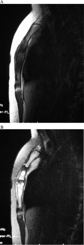 Figure 3.  Magnetic resonance imaging (MRI). The signal intensity of the tumor was low in the sternum on T1-weighted images (A) and high on T2-weighted images (B).