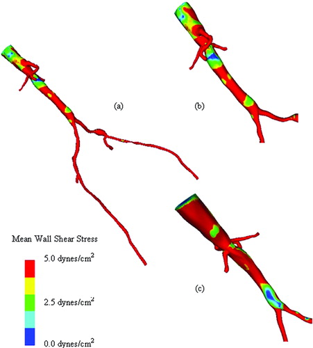 Figure 12. Mean wall shear stress for preoperative model. (a) shows the mean wall shear stress for the entire preoperative model. (b) shows a zoomed anterior view of the infra-renal aorta, while (c) shows a posterior view of the infra-renal aorta. Notice the region of low mean wall shear stress located just proximal to the aortic bifurcation, an area predisposed to atherosclerosis.