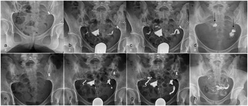Figure 1. Preoperative and postoperative HSG showing fallopian tube improvement. (A) Preoperative pelvic image. (B,C) Radiography showing displayed uterine cavity; the fallopian tube was displayed to the distal end of the ampulla, with no iodised oil at the umbrella end. (D) Pelvic review image after 24 h. The iodised oil was accumulated on the umbrella end of the bilateral fallopian tubes (small white arrows), and not diffused in the pelvic cavity. (E) Pelvic image after operation. (F,G) Radiography showing the uterine cavity and the fallopian tube till the umbrella end; the iodised oil overflowed into the pelvic cavity. (H) Pelvic cavity review image showing that iodised oil was evenly distributed to the pelvic cavity 24 h later.