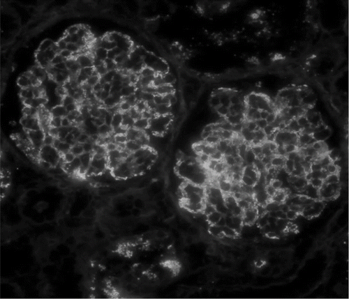 FIGURE 1. Immunofluorescence staining for IgA in a patient with diffuse endocapillary proliferative glomerulonephritis shows 2+ granular deposition in predominantly glomerular capillary loops (original magnification ×400); there is also 2+ staining for C3 in a similar pattern (not shown).