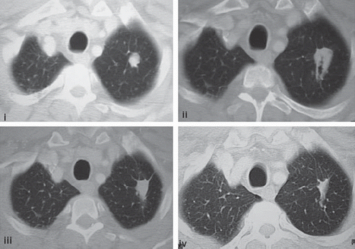 Figure 1. Representative images of lung metastases (i) pre-RFA treatment, (ii) one month post-RFA, (iii) six months post-RFA, and (iv) 18 months post-RFA where the target lesion demonstrates initial expansion of the size of the lesion as a result of cavitation, necrosis, and/or cyst formation leading to reduction in size over time.