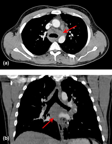 Figure 1a and b. Axial and coronal cuts of CT-scans of thorax showing multiple enlarged mediastinal lymph nodes