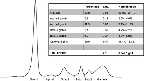 Figure 2 Capillary zone electrophoresis. A decrease of the alpha-1 globin peak is notable.