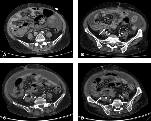 FIGURE 1. A CT scan of the abdomen in a patient on peritoneal dialysis who presented with peritonitis. (A) The first CT scan showed ascites in the abdominopelvic cavity, with some particular peritoneal thickening with enhancement in the pelvic cavity, suggesting possibility of peritonitis. (B) The second CT scan showed increased ascites, peritoneal thickening with enhancement, and thickening of the diffuse bowel loop, suggesting peritonitis and reactive bowel wall thickening, and dilatation and increased enhancement of appendiceal loop (arrow). (C, D) The third CT scan demonstrated perforated appendicitis with peri-appendiceal abscess (arrow).
