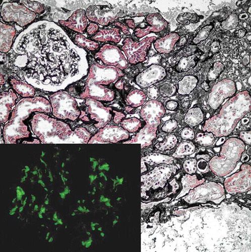 Figure 3.  Mild tubular atrophy with interstitial fibrosis is noted at right side of the picture (Jone’s methanamine silver stain, × 200 magnification). Inset shows deposition of IgA in the mesangial regions (imunofluorescence, fluorescein isothiocyanate-conjugated anti-IgA antibody ×400).