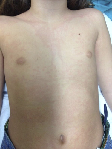 Figure 3. The picture shows an erythema marginatum preceding an angioedema acute attack in a patient with type I HAE. The erythematous rash with circular polycyclic border and a clear center should not be confused with urticaria.