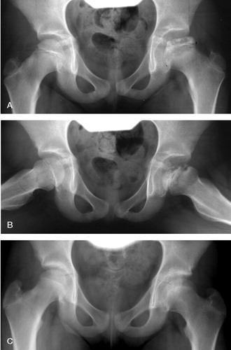 Figure 1. A 7-year-old girl with Perthes' disease of the left hip. She had symptoms for 1 month before diagnosis (pain and limping gait). A and B. At 1-year follow-up, showing Perthes' disease classified as Catterall group 3 and lateral pillar group B. C. At 5-year follow-up, showing good radiographic outcome with spherical femoral head.