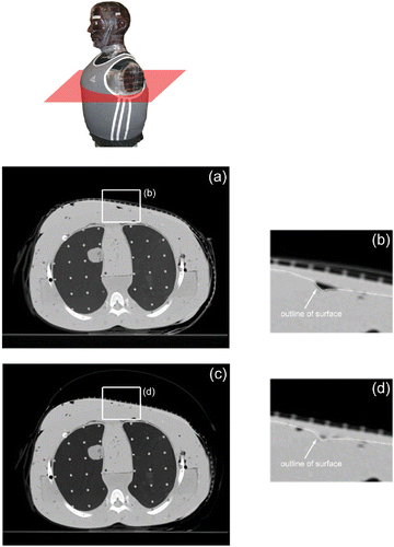 Figure 5. Axial CT cross-sections from the upper torso of a CT phantom fitted with the multilayer conformal applicator. (a) Axial cross-section of the upper torso prior to air bladder inflation; (b) close-up of the bolus over the breast and sternum prior to air bladder inflation; (c) axial cross section of the upper torso after air bladder inflation; (d) close-up of the bolus over the breast and sternum after air bladder inflation.