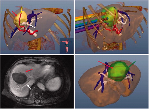 Figure 1. Images of a 70-year-old female patient with a tumour at the border of the left and right lobe. (A) Preoperative 3D images visualised the spatial relationship of the tumour (red arrow) and the surrounding nutrient artery (yellow arrow), portal vein (blue arrow) and hepatic vein (white arrow) in multiple angles. (B) Ablation protocol was achieved through three-dimensional visualisation of the preoperative planning system, and six needles were needed to ablate the tumour completely. (C) The contrast-enhanced magnetic resonance imaging showed complete tumour necrosis (red arrow) one month after microwave ablation without hepatic vein (white arrow) injury. (D) Three-dimensional visualisation software system showed that the ablation zone (green arrow) covered the tumour (red arrow) completely one month after microwave ablation.