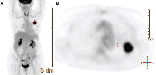 Figure 1. Display of a maximum intensity projection (MIP) in coronal view (A), as well as a transverse PET slice reconstructed by CT attenuation correction. A solitary, FDG avid mass is recognized in projection onto the left lung. Corresponding pathology represents a NSCLC. Tumor stage by imaging and biopsy sampling of mediastinal nodes was T1N0M0.